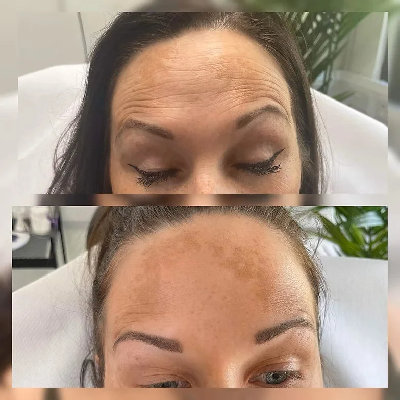 Forehead Before &amp; After