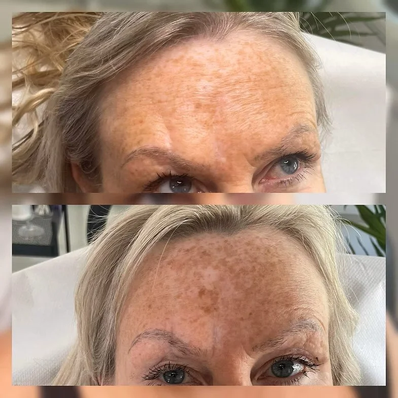 Forehead Before &amp; After