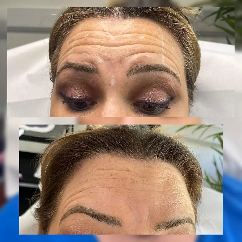 Forehead Before &amp; After