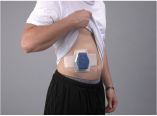 Person with a white T-shirt lifted to reveal a small blue rectangular device attached to their abdomen.