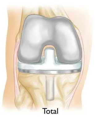 Diagram of a knee replacement showing a metal implant and artificial joint.