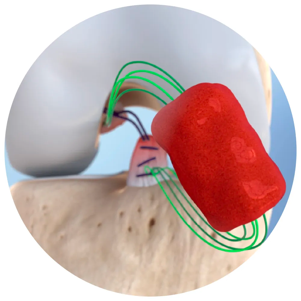 Illustration of a dental implant surgery showing a grafted bone, a titanium post, and an abutment with a dental crown.