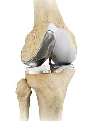 A human knee joint with an artificial knee prosthesis