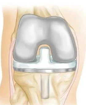 Illustration of a knee joint with a metallic prosthetic implant replacing the damaged joint.