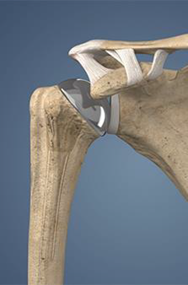 Close-up of a human shoulder joint with a metallic prosthetic shoulder replacement.