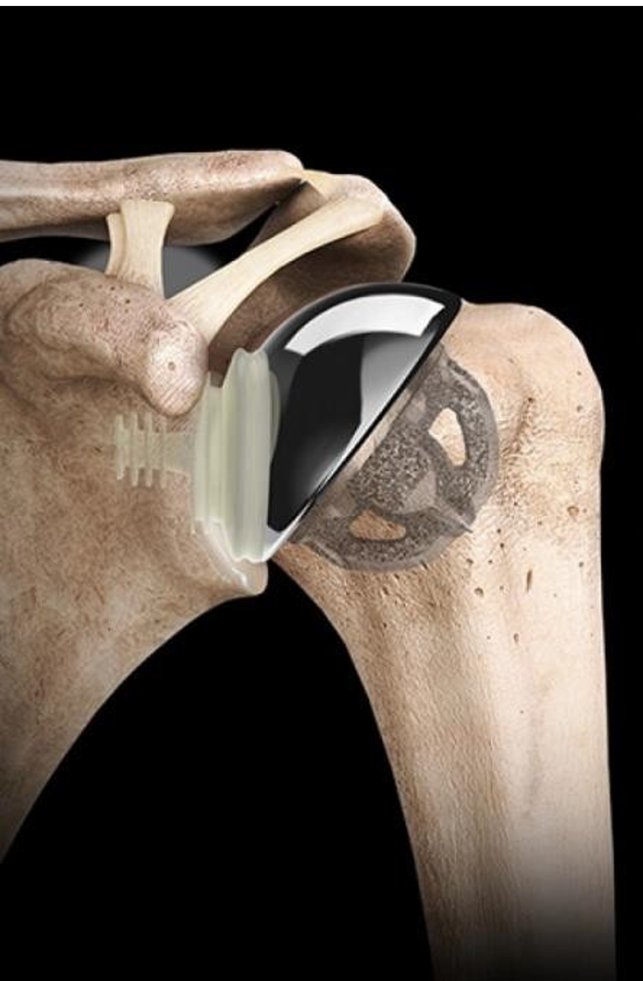 A close-up of a human shoulder joint model showing bones, with a mechanical device inside the shoulder socket.