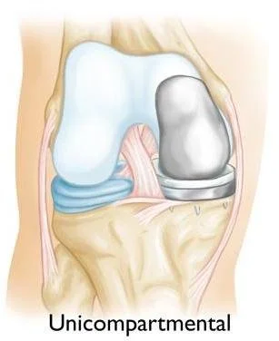 A medical illustration of a unicompartamental knee implant showing the knee joint with a single component replacing joint surfaces.