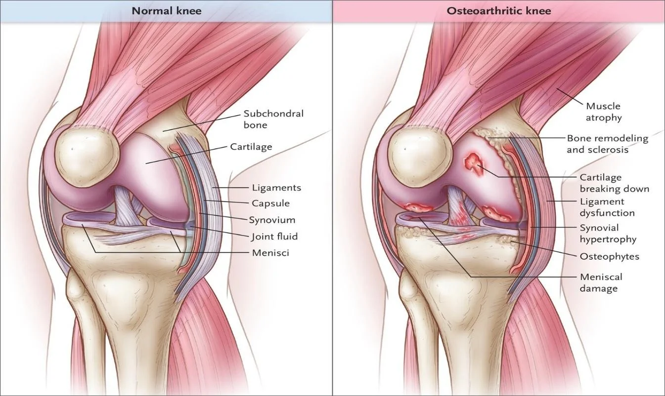 Comparison of normal knee and osteoarthritic knee showing muscle atrophy, bone remodeling and sclerosis, cartilage break down, ligament dysfunction, synovial hypertrophy, osteophytes, and meniscal damage.