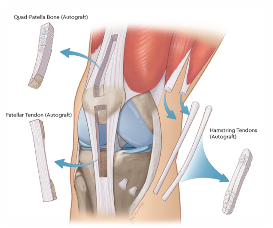 Illustration of knee anatomy showing autografts used in surgical repair, including the quadriceps patella bone, patellar tendon, and hamstring tendons.