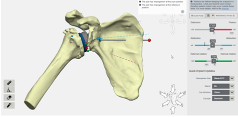 3D medical diagram of a human shoulder joint, including the humerus, scapula, and clavicle, with measurement and adjustment tools visible.