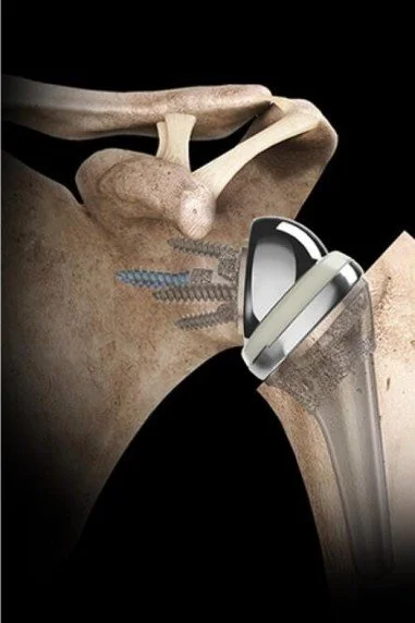 A skeleton pelvis with a prosthetic hip joint and screws, showing a hip replacement.