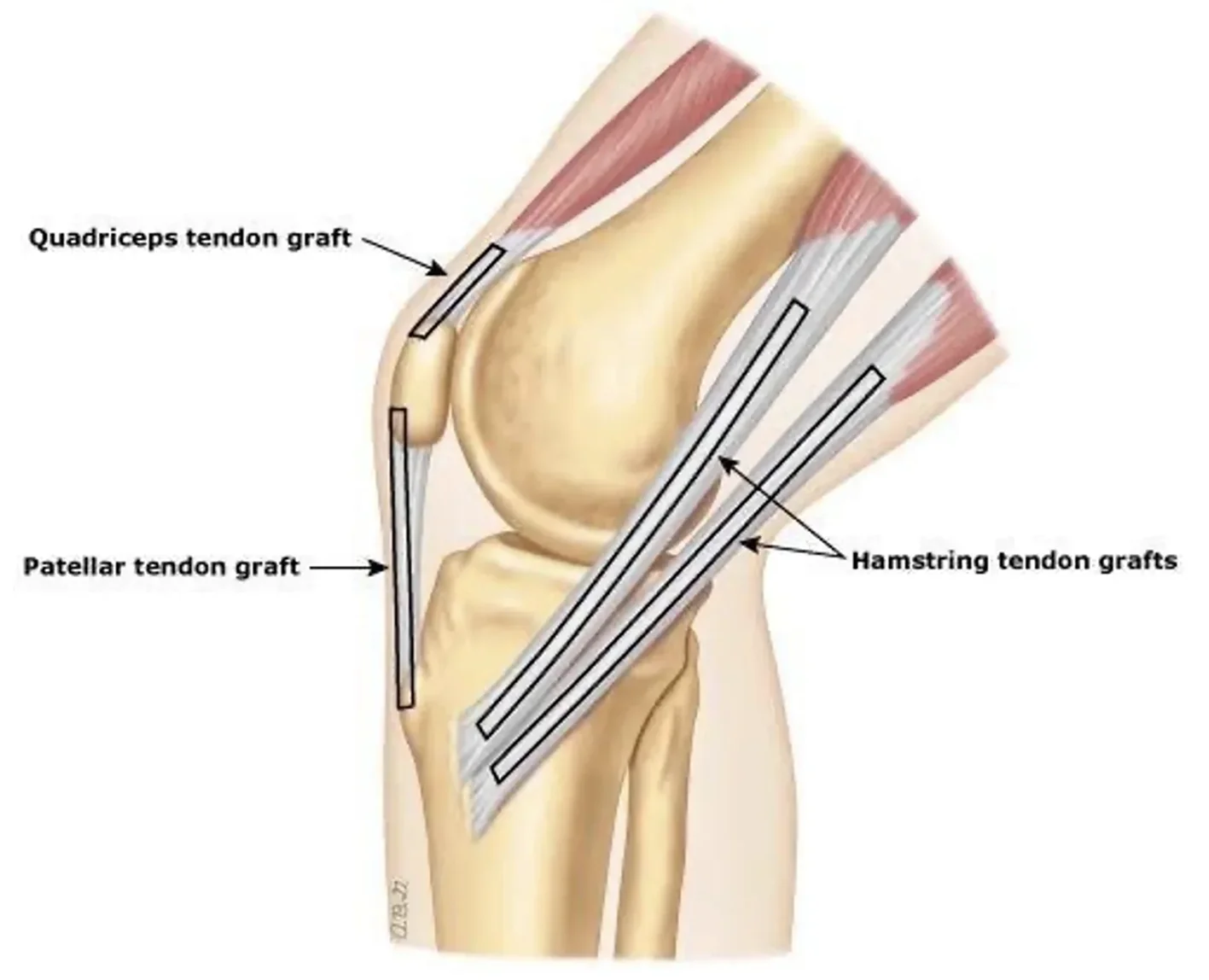 ACL graft choices: what are the options?
