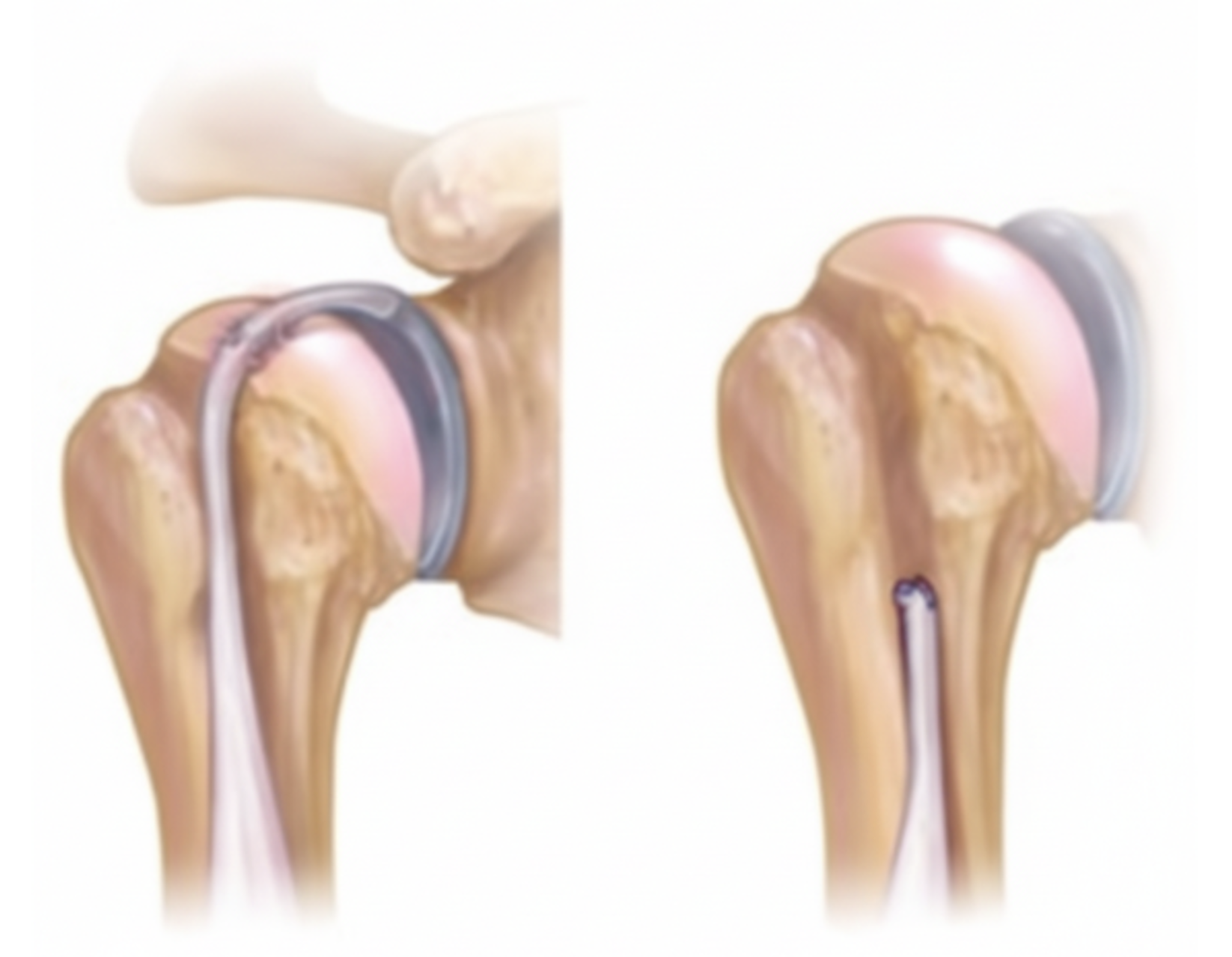 How is a long head Biceps Tenodesis/Tenotomy performed?
