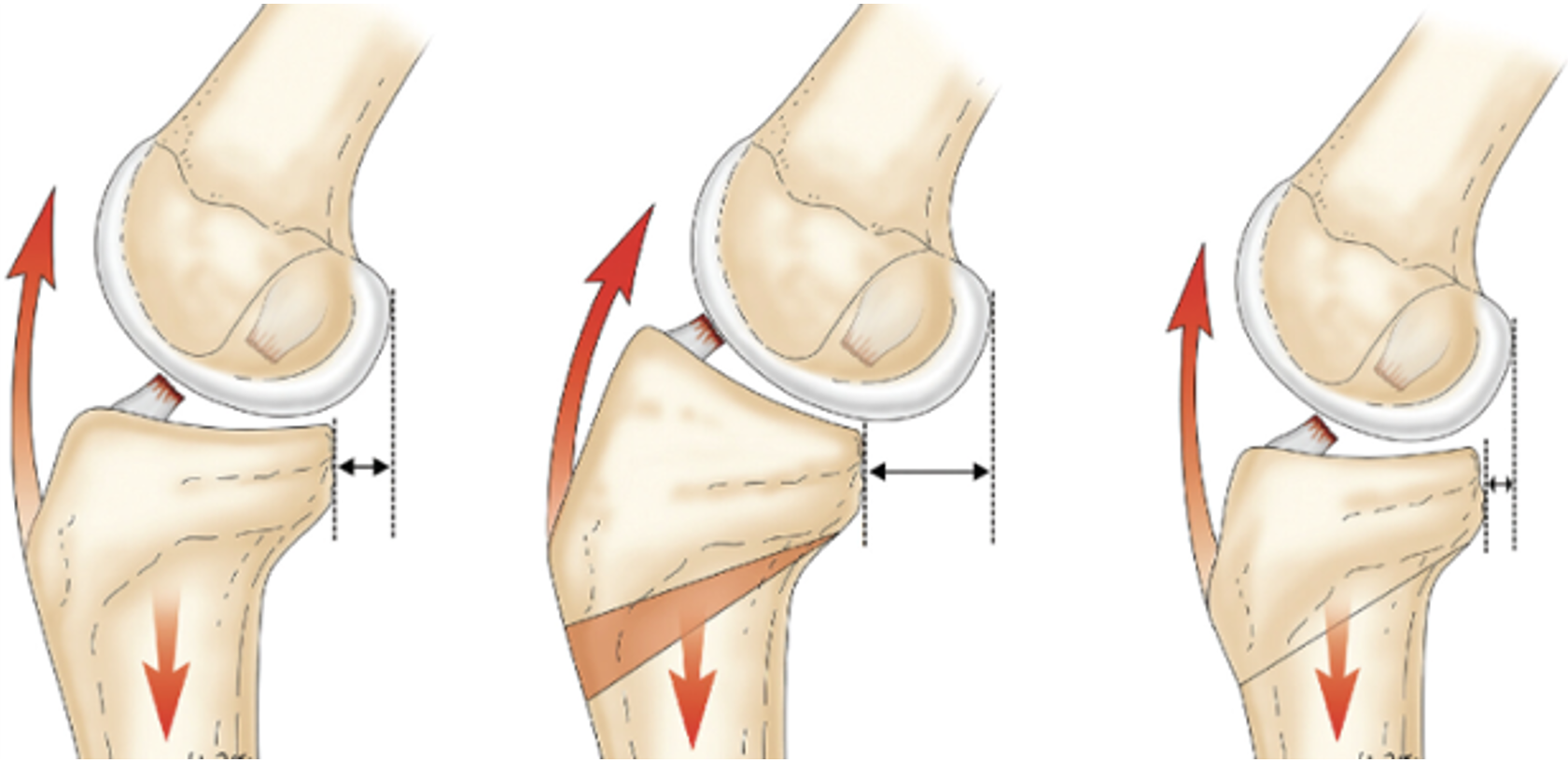 How Is a Revision ACL Reconstruction Performed?