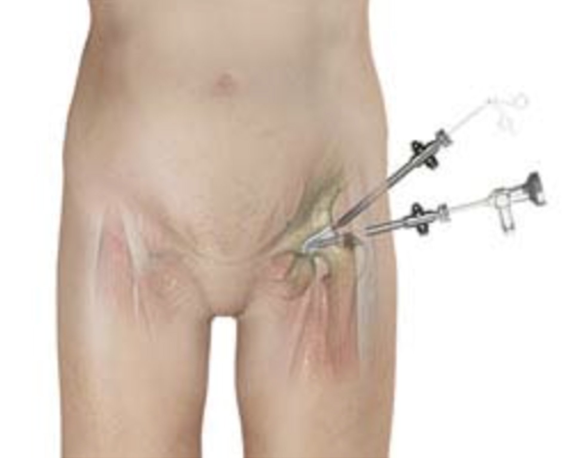 Understanding the Hip Labrum: What It Does, Why It Tears, and How It's Repaired