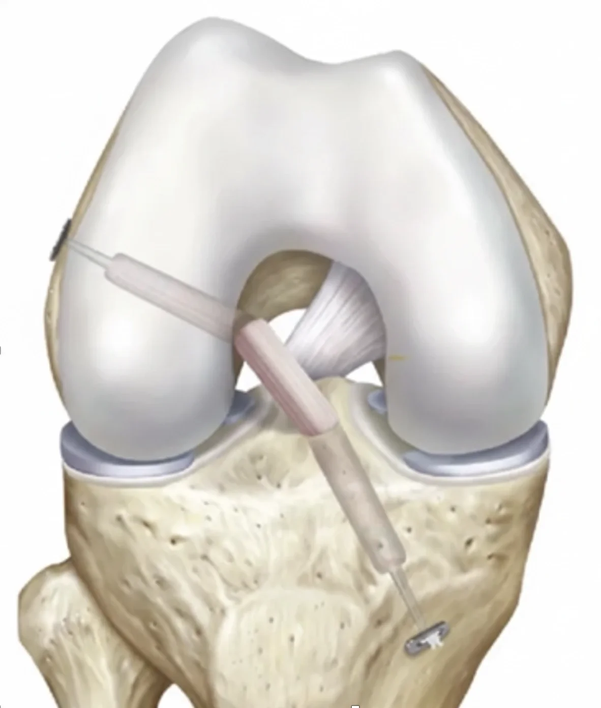 How Is an ACL Reconstruction Performed?
