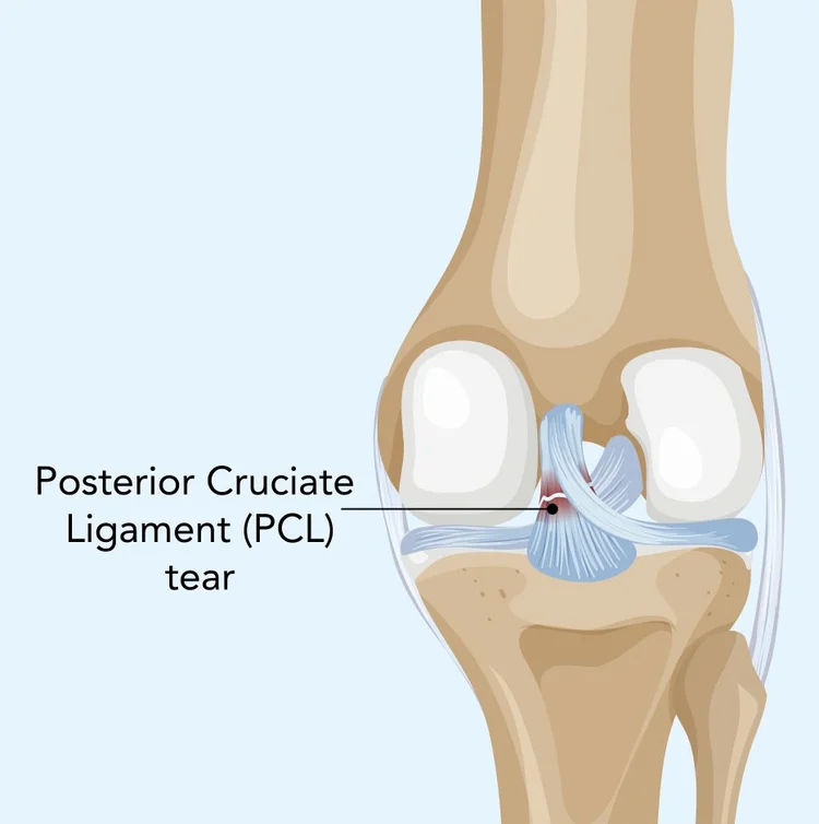 Pcl Injuries Posterior Cruciate Ligament (PCL) Injury — Mr Ian Al'Khafaji ...