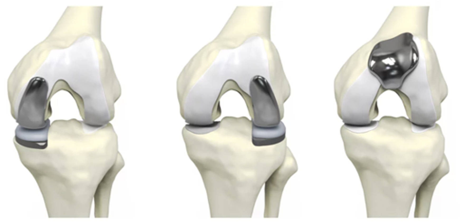 How is a UKR Performed?