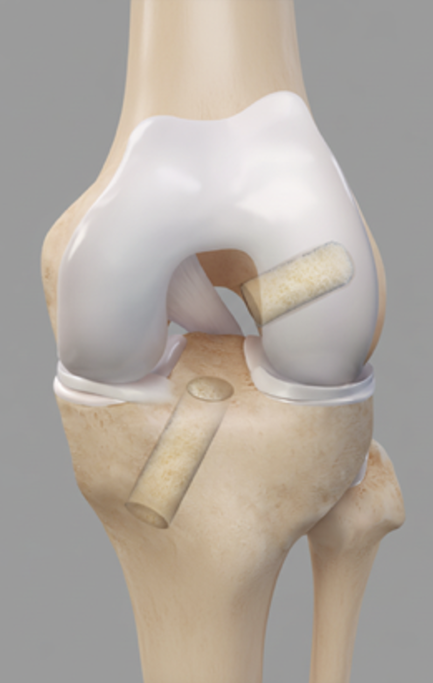 How Is a Revision ACL Reconstruction Performed?