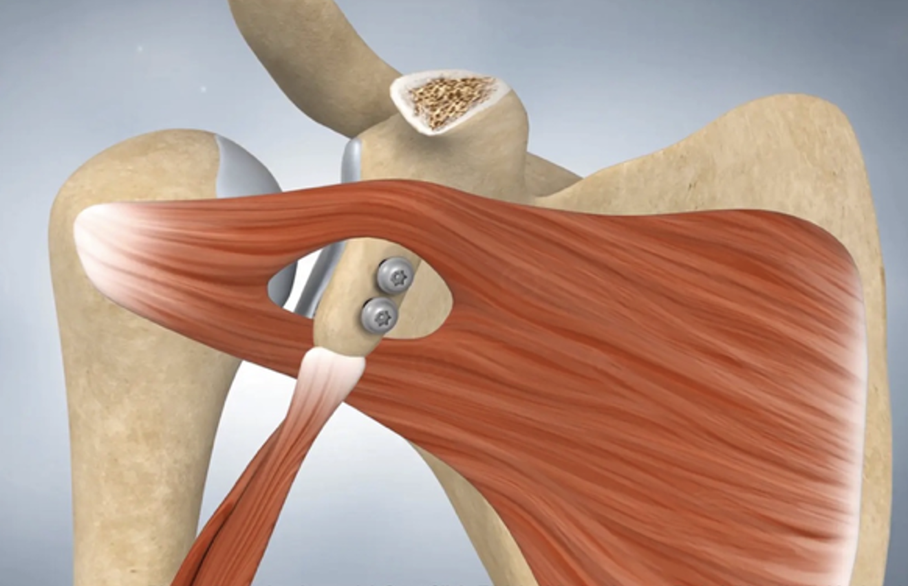 How Is Latarjet Shoulder Stabilization Performed?