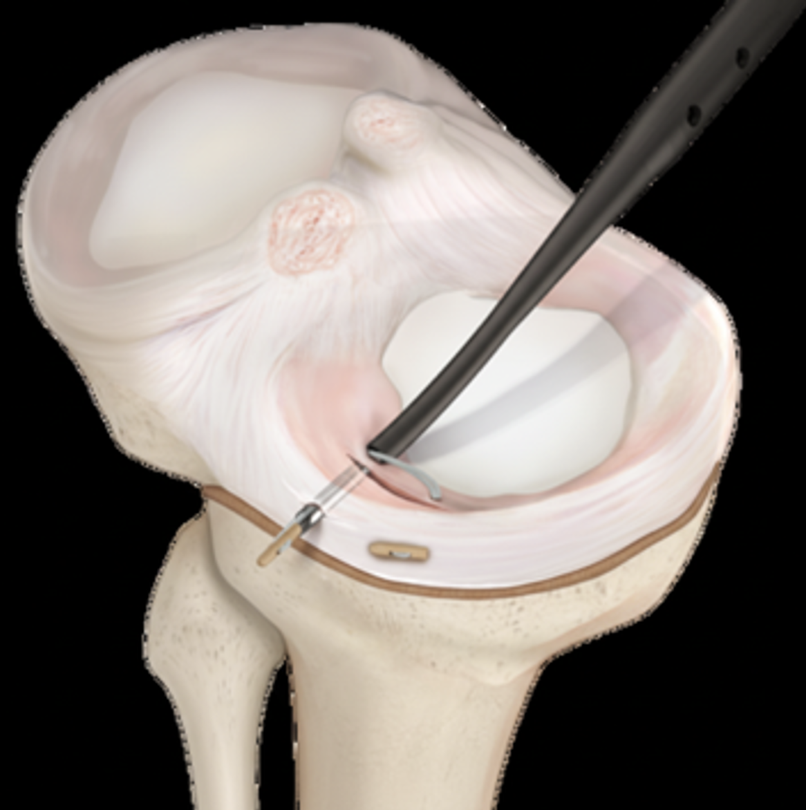 How is a Meniscus Repair performed?