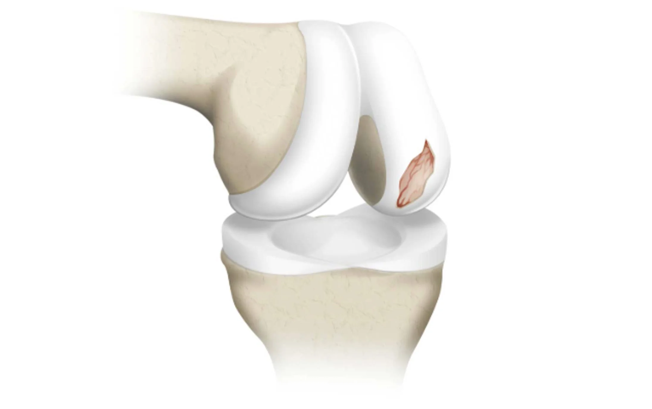 Cartilage Injuries in the Setting of an ACL Injury Mr Ian Al'Khafaji Melbourne ACL Repair Surgery