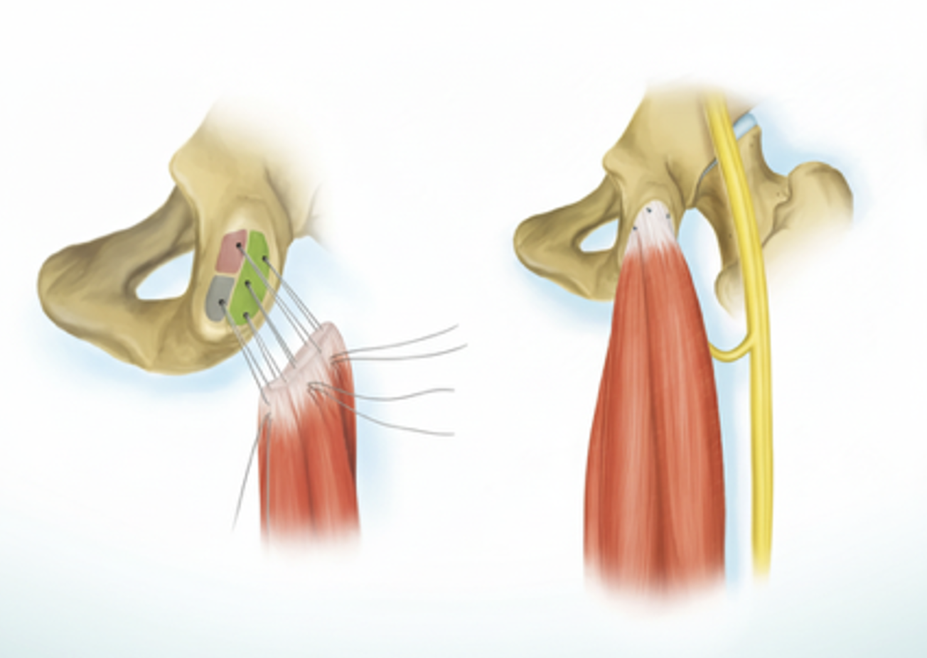Understanding the Anatomy of the Abductor Tendons