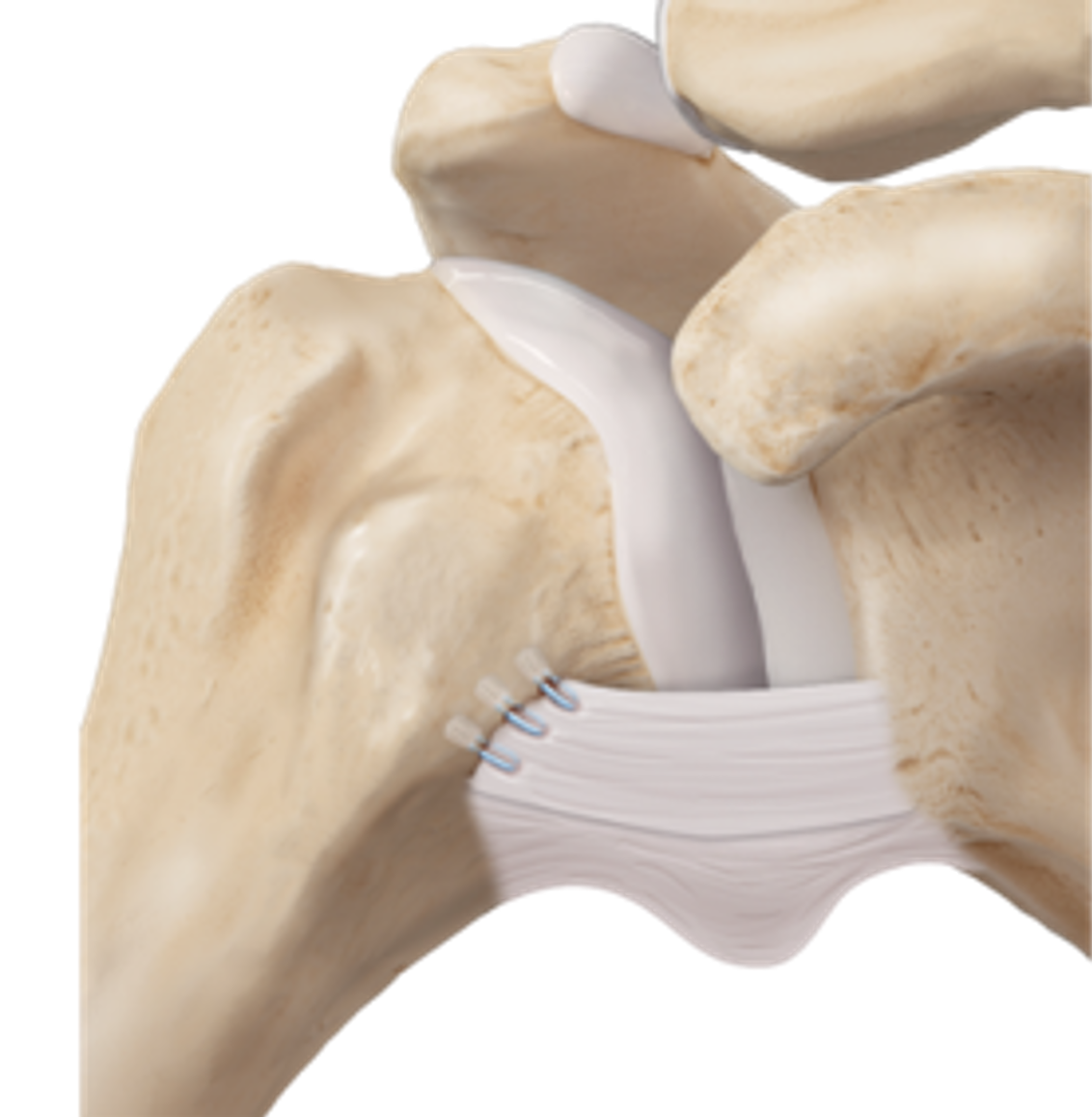 How Is Arthroscopic Shoulder Stabilization Performed?