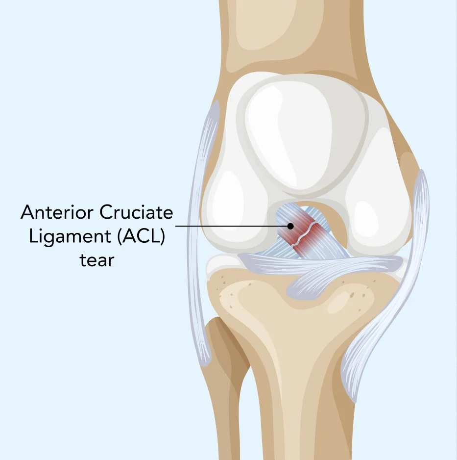 Anterior Cruciate Ligament (ACL) Injury — Mr Ian Al'Khafaji | Melbourne ...