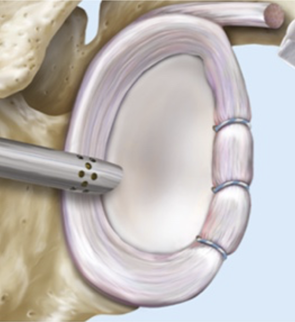 How Is Arthroscopic Shoulder Stabilization Performed?