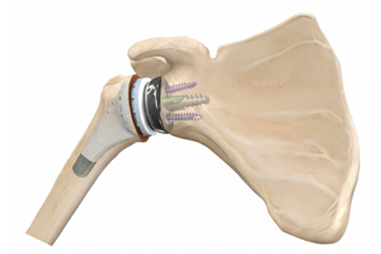 How Is Reverse Total Shoulder Replacement Performed?