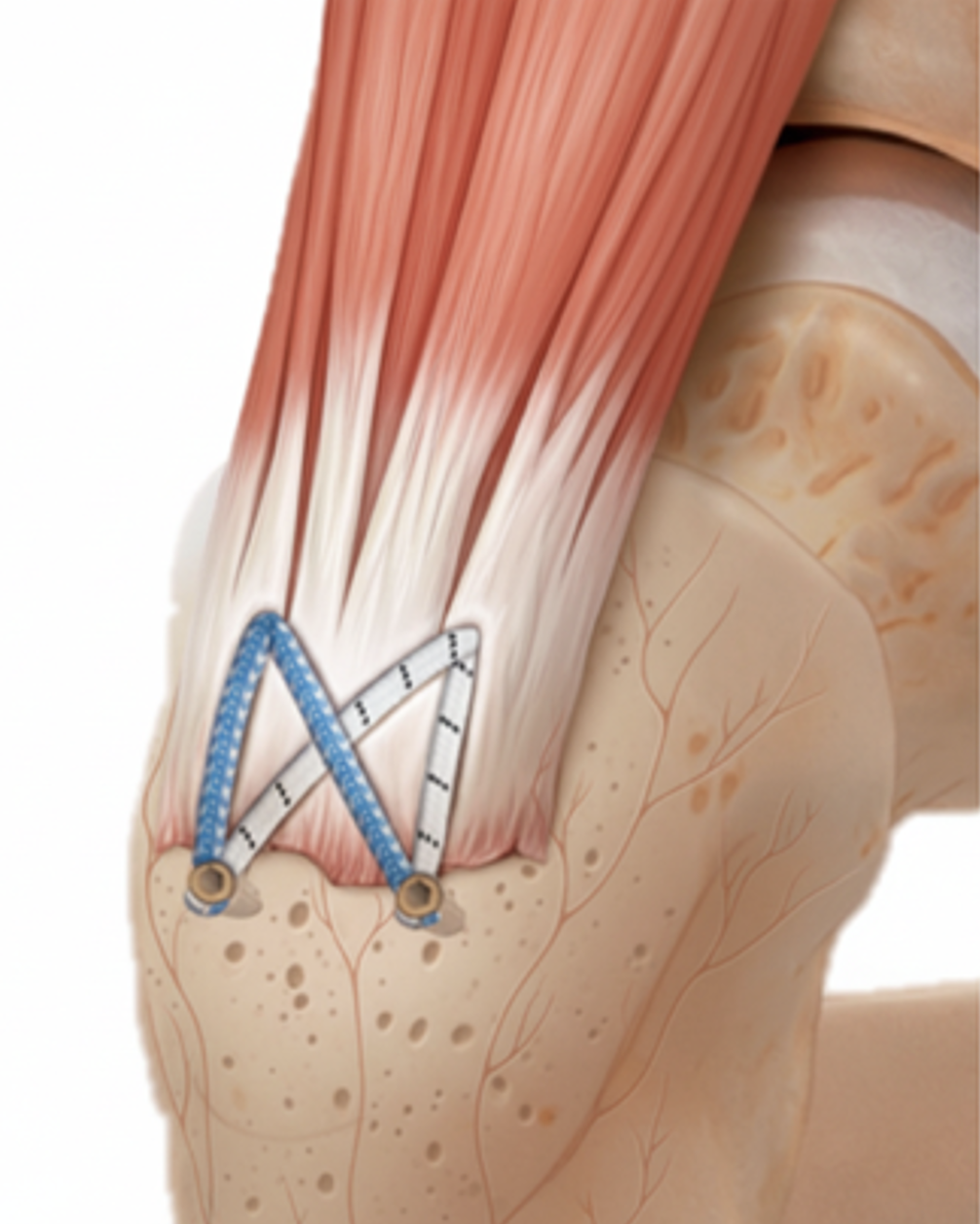 Anatomy of the Abductor Tendons