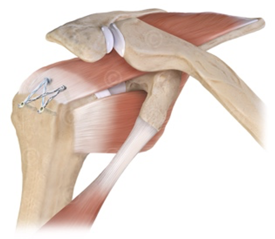 How Is Rotator Cuff Repair Performed?