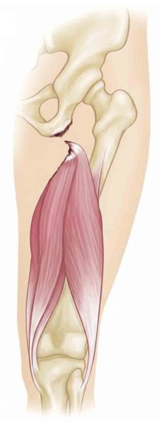 Proximal Hamstring Tear Dr Ian Al'Khafaji Orthopaedic hip Surgery Melbourne Centaur VIC