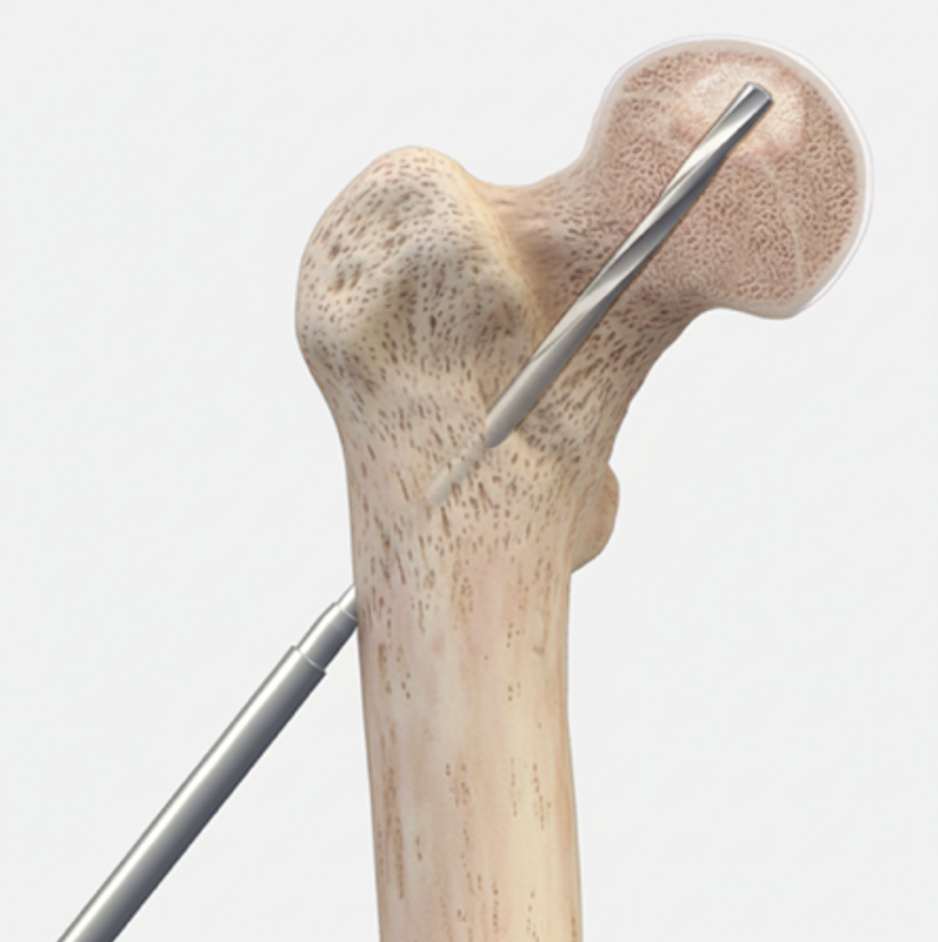 What is Avascular Necrosis of the Hip?