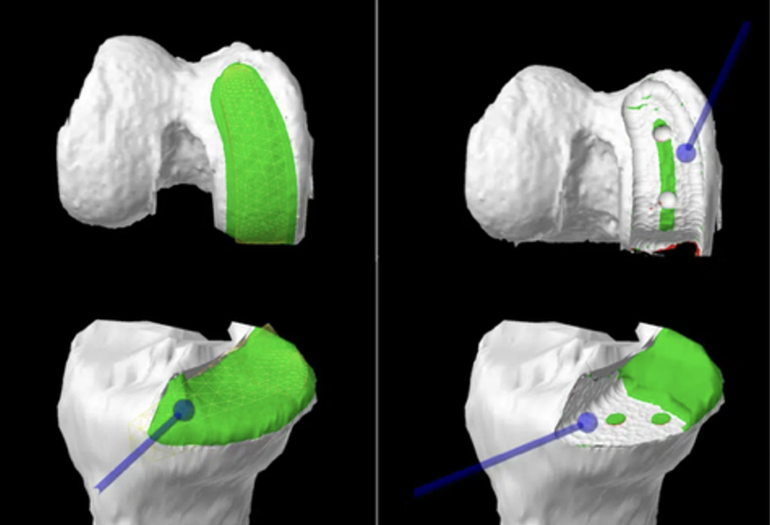 How Does a Robot Help with Performing a UKR?