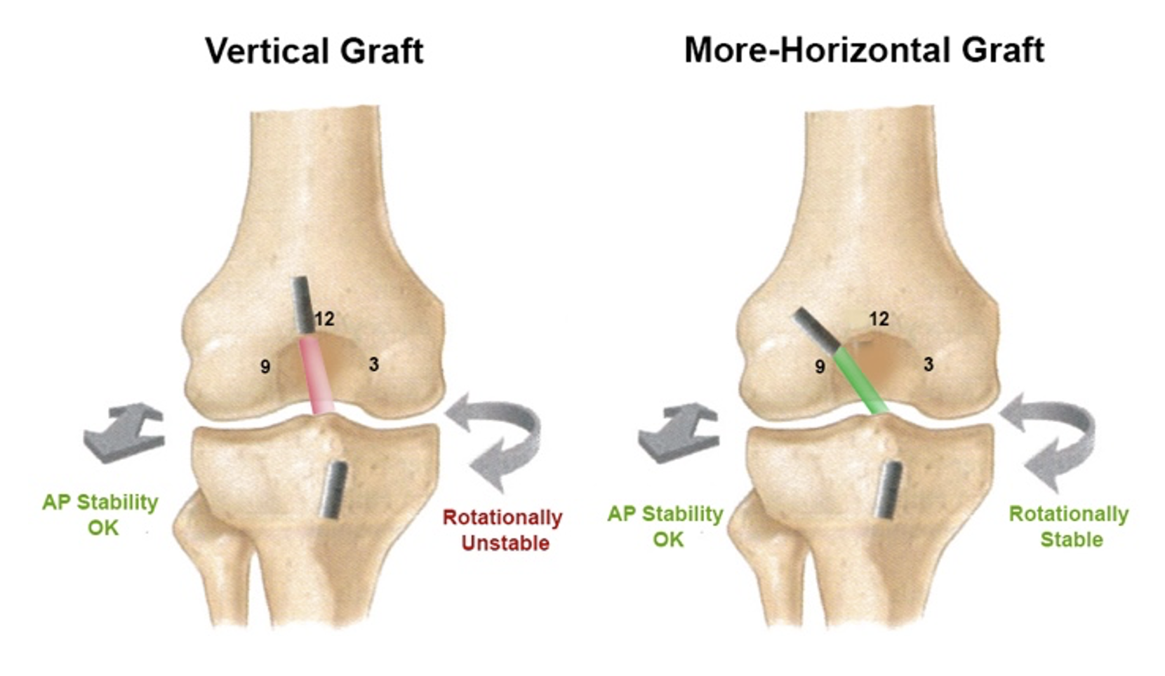 Why Do ACL Reconstructions Fail?