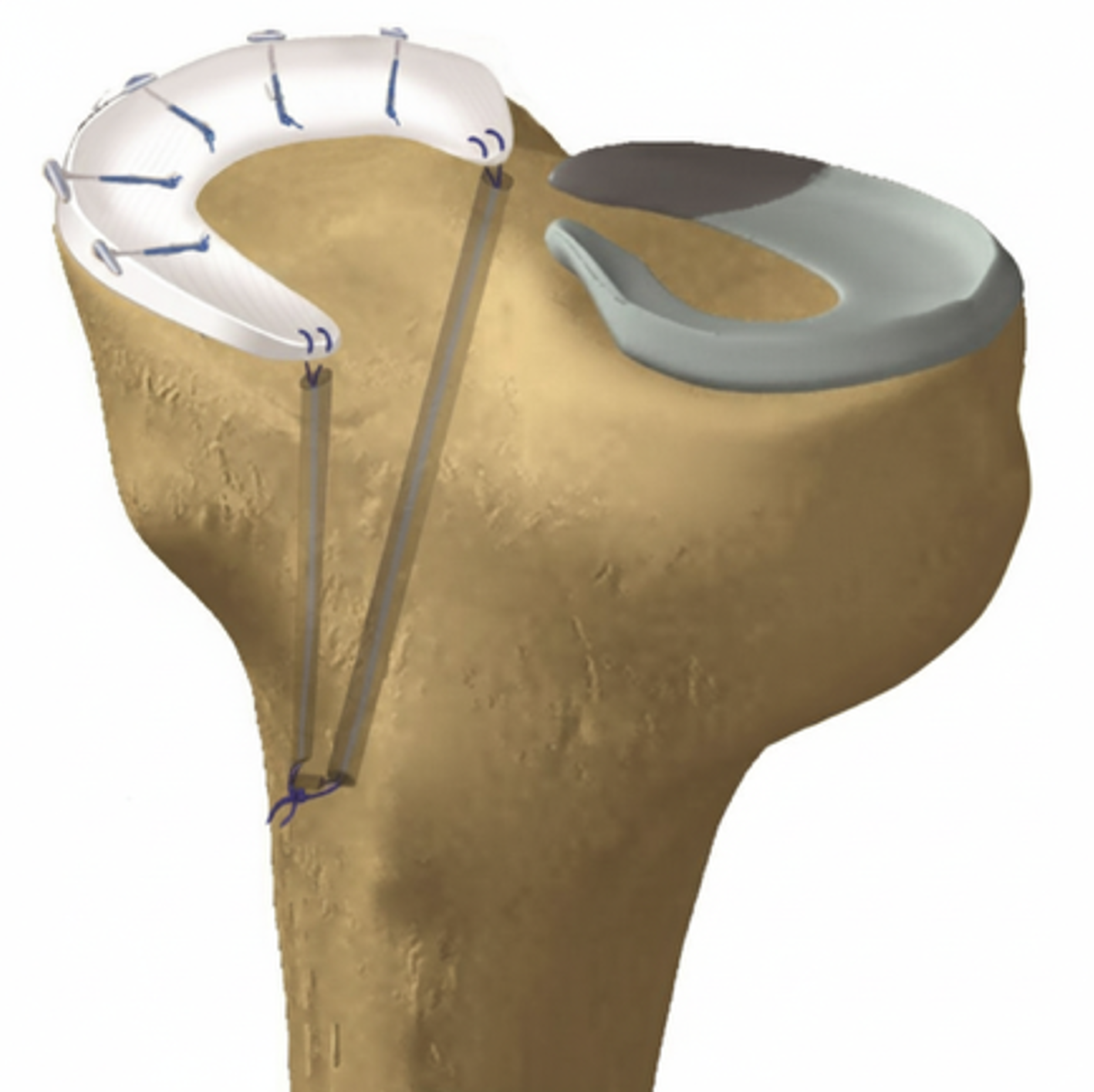 How is a Meniscus Transplant Performed?