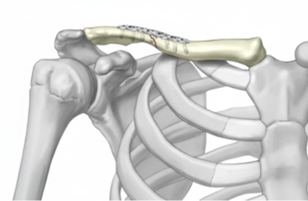 How is Clavicle Fracture Fixation Performed