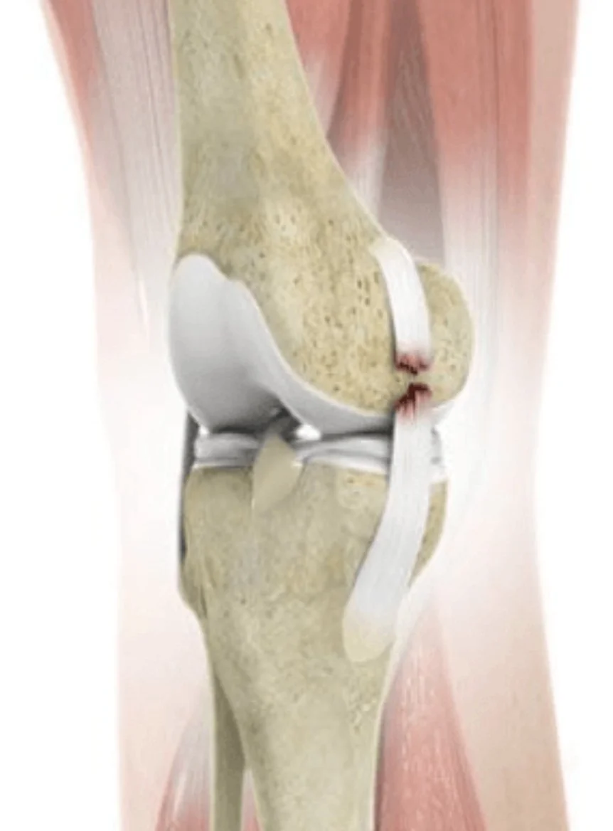 MCL Injuries in the Setting of ACL Reconstruction