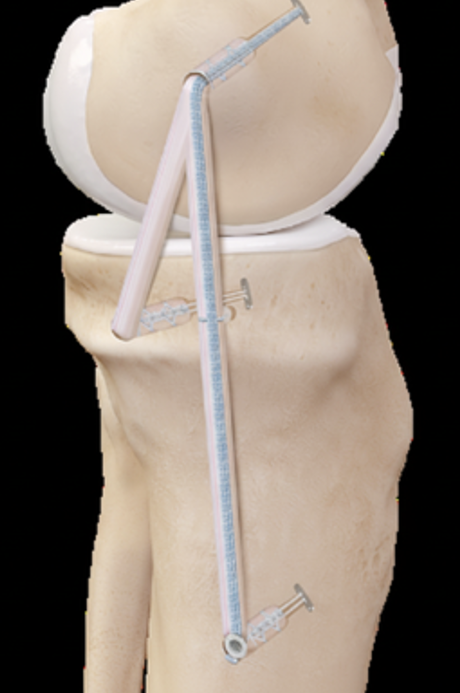 How is an MCL Repair or Reconstruction Performed?