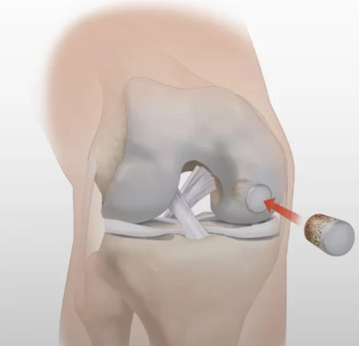 Cartilage Injuries in the Setting of an ACL Injury Mr Ian Al'Khafaji Melbourne ACL Repair Surgery