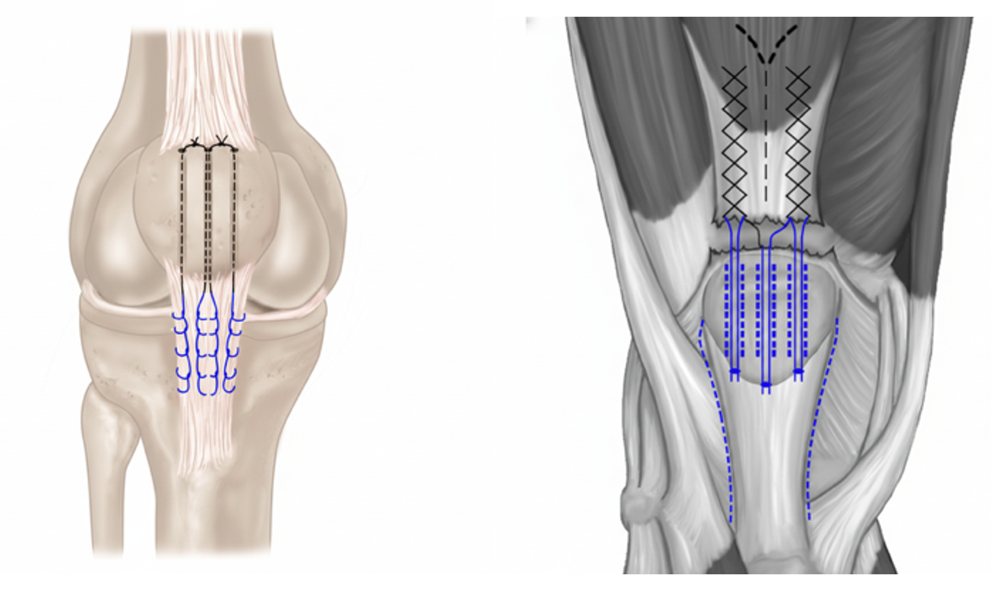 How is a Patella / Quadriceps Tendon Repair Performed?