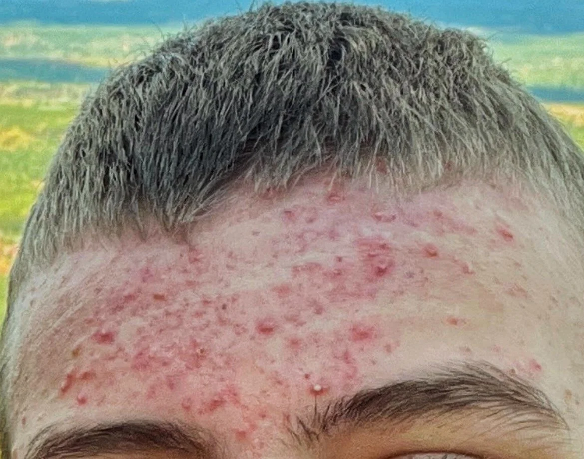 My Son’s Cystic Acne Nightmare – How Drugstore “Treatments” Made It Worse