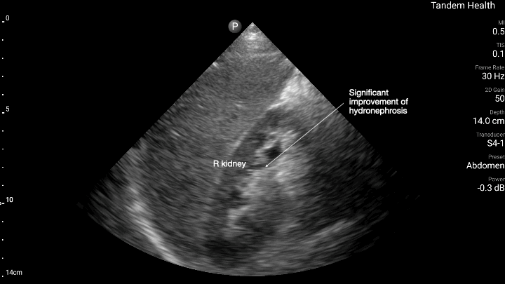 Complications of prostate enlargement (BPH) 