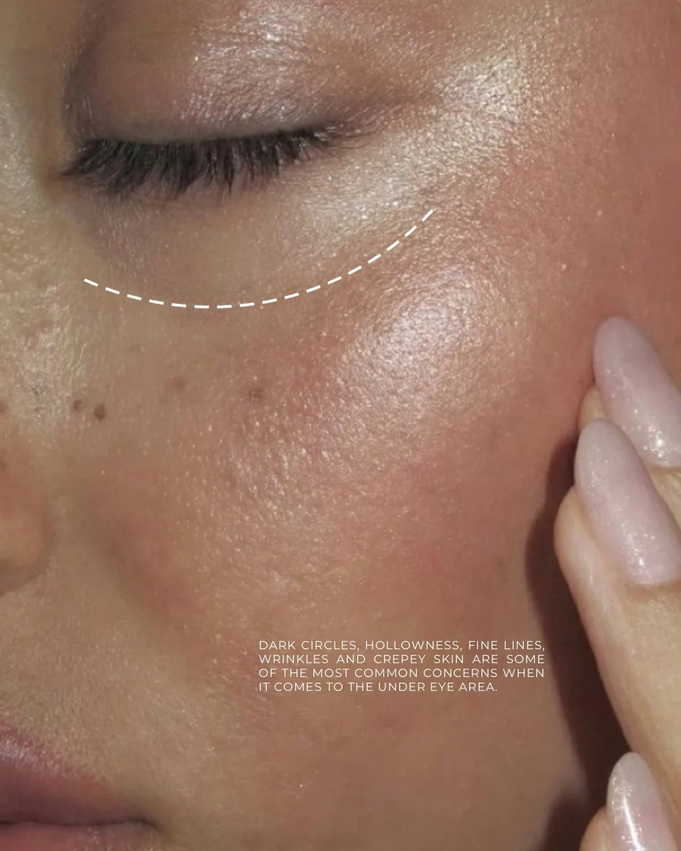 Are your under eyes making you look tired, aged or exhausted?

Dark circles, hollowness, fine lines, wrinkles and crepey skin are some of the most common concerns I see in clinic. The under eye area is incredibly delicate and is often one of the firs