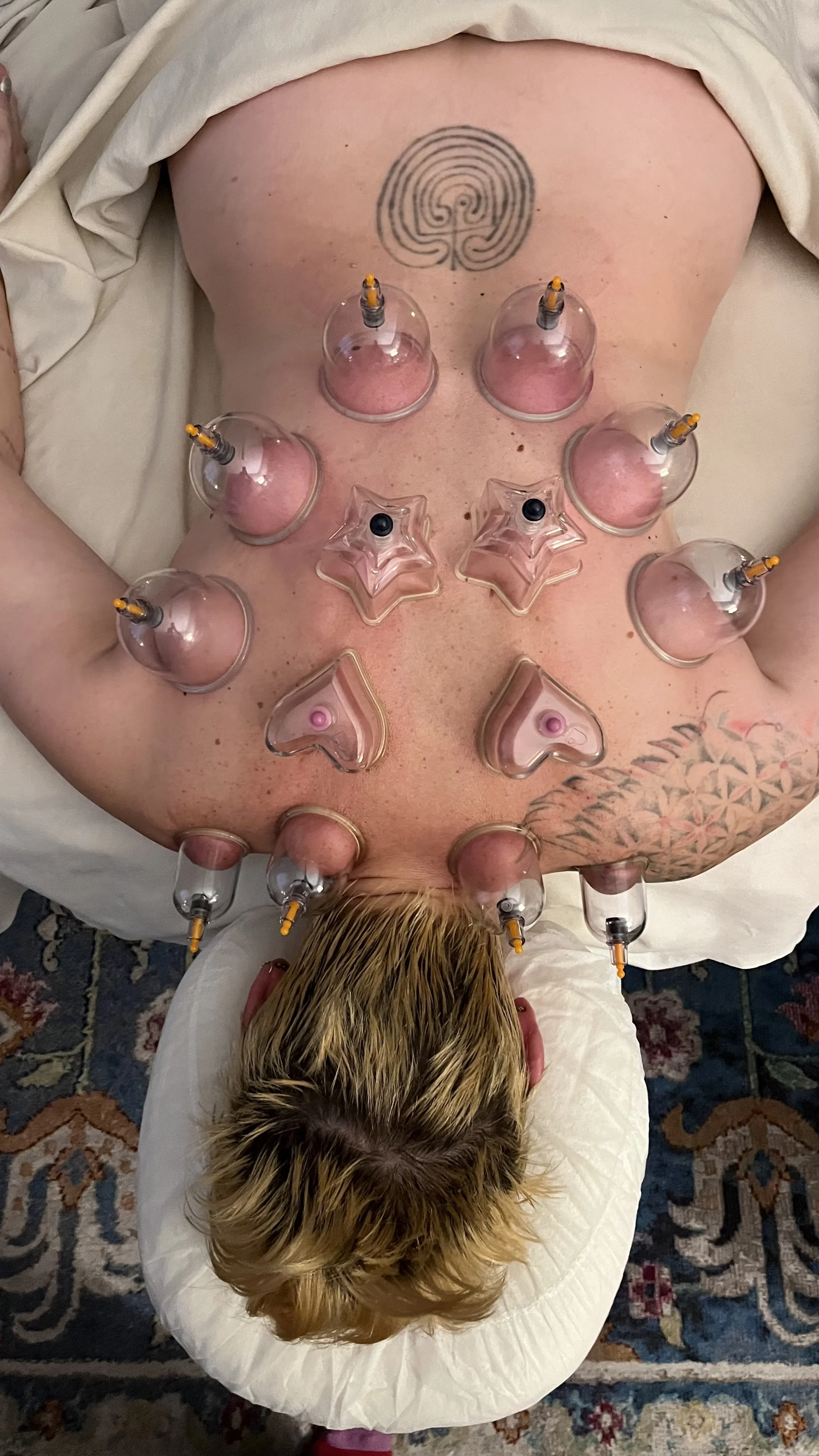 A person lying face down on massage table receiving cupping therapy with multiple cups placed on their back.