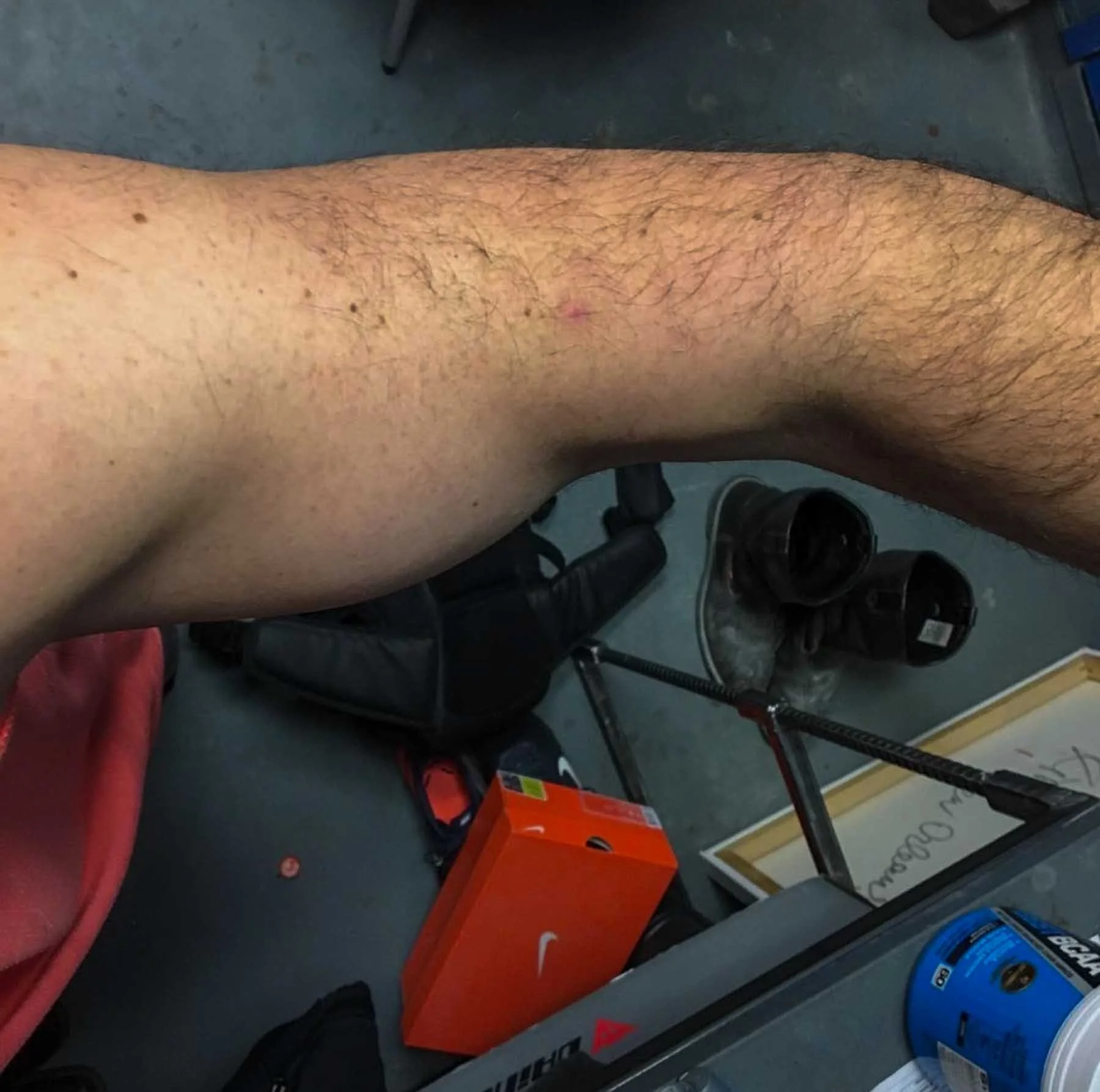 Left arm showing detached bicep tendon injury following a concrete installation project.