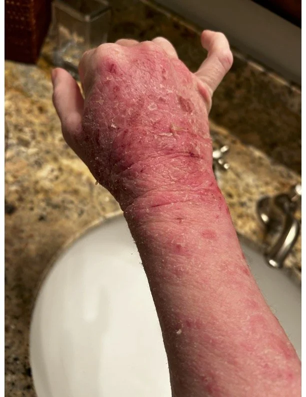 Close-up of a person's arm with severe skin redness and peeling, showing signs of skin damage or a skin condition.