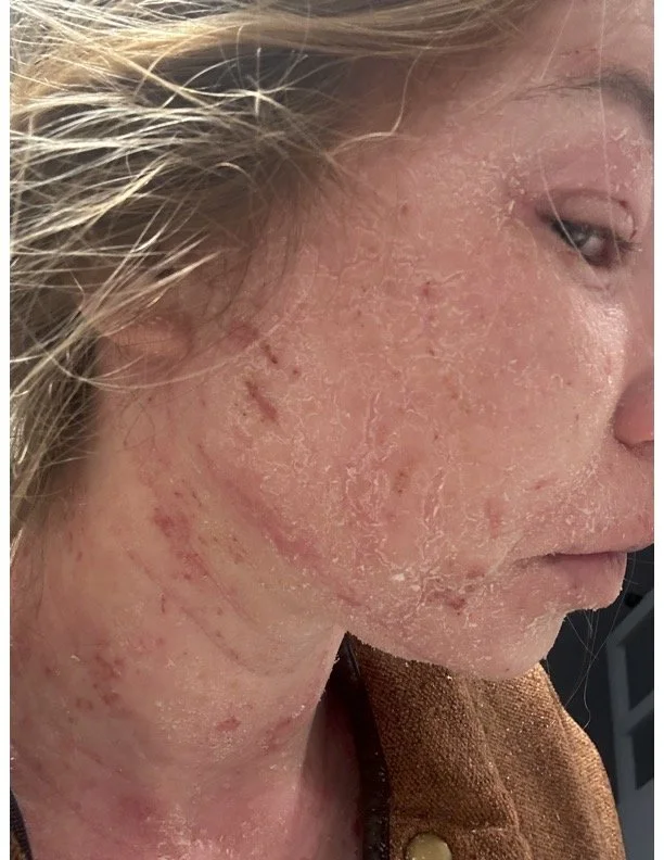Close-up of a woman's face and neck with red, irritated, and peeling skin, indicating a skin condition such as eczema or dermatitis.